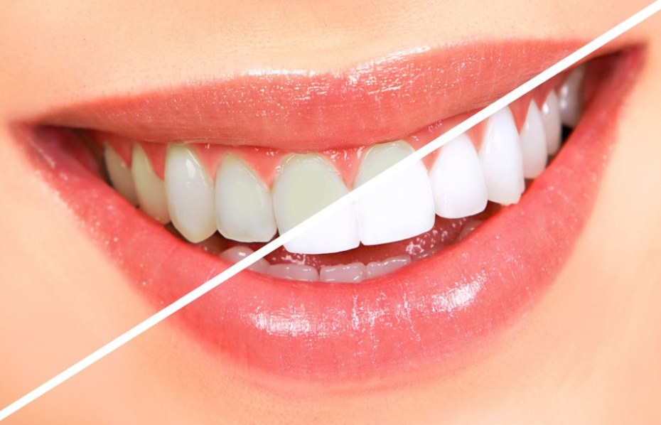35€ από 100€ για Ολοκληρωμένη Λεύκανση Δοντιών, για δόντια έως 3 τόνους πιο λευκά, στο Οδοντιατρικό Κέντρο ''Kremmydas Dental Project'' στην Πατησίων